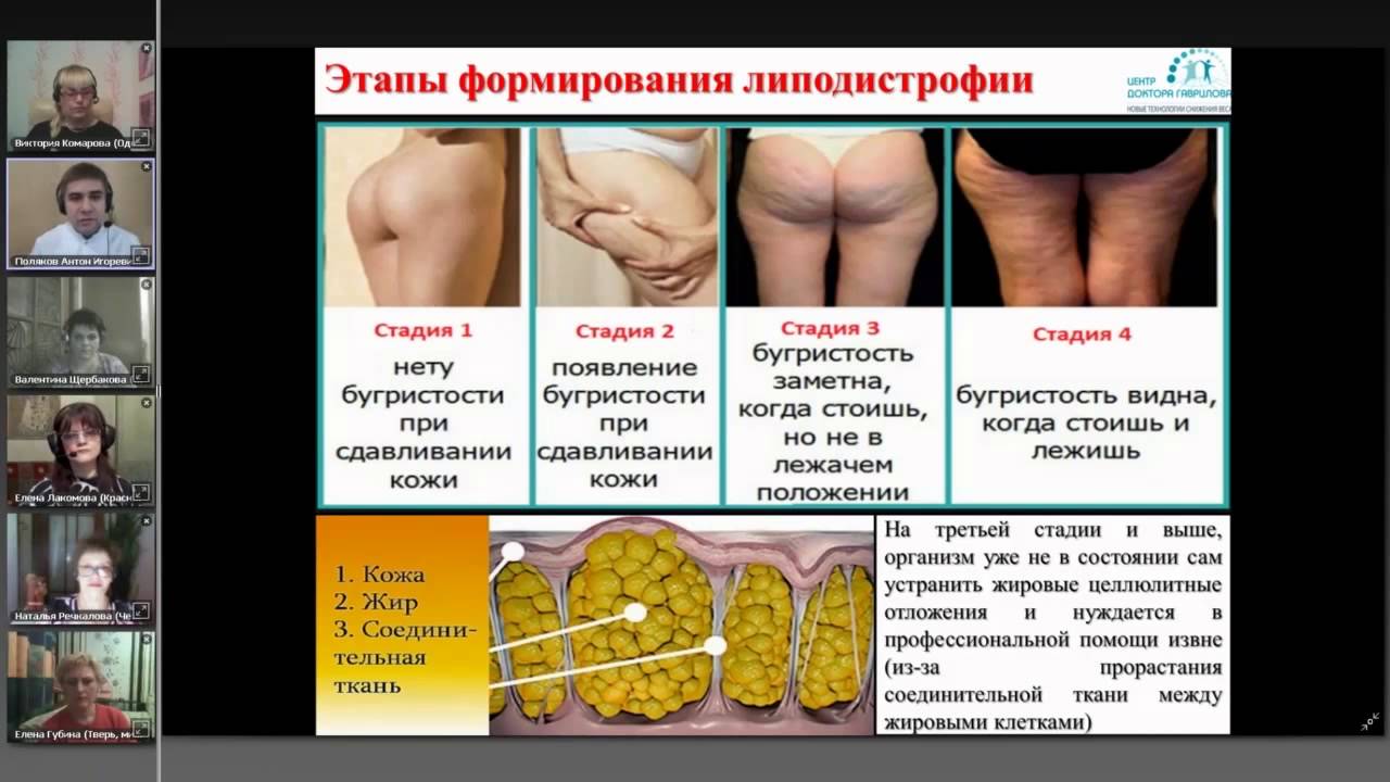 Что такое целлюлит и как с ним бороться