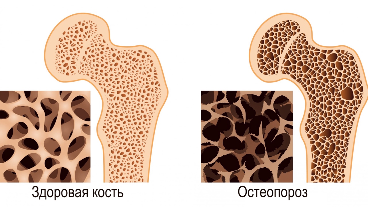Остеопороз